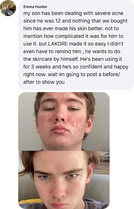Parent review: teen nearly hopped on Accutane but Lakore cleared skin instead