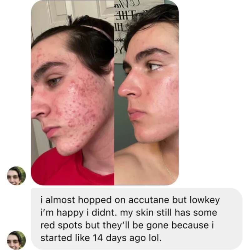 Parent review: teen acne cleared completely after Lakore treatment