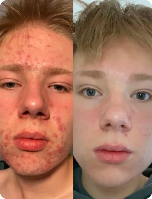 Acne Before and After Comparison